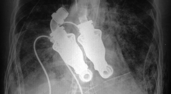 Dual Ventricular Assist Device